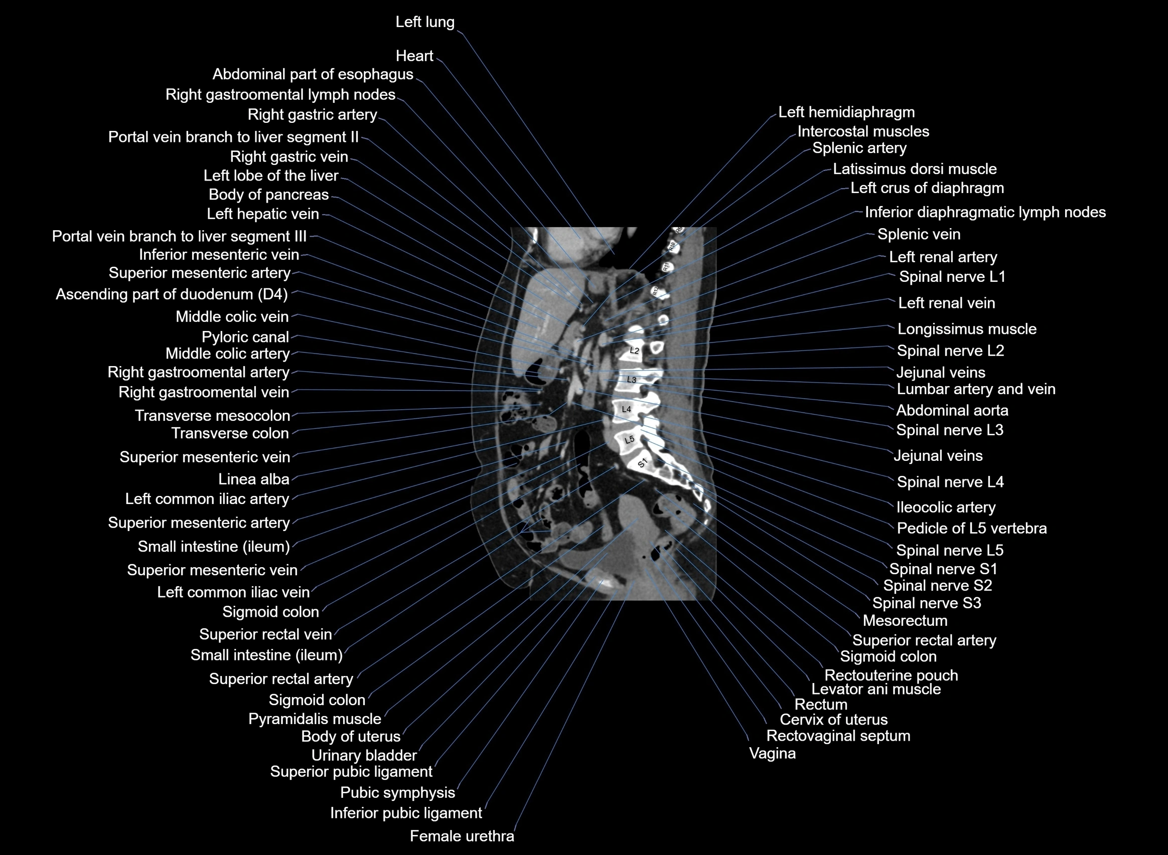 CT Abdomen sagittal cross sectional anatomy labelled radiology image -00055.webp